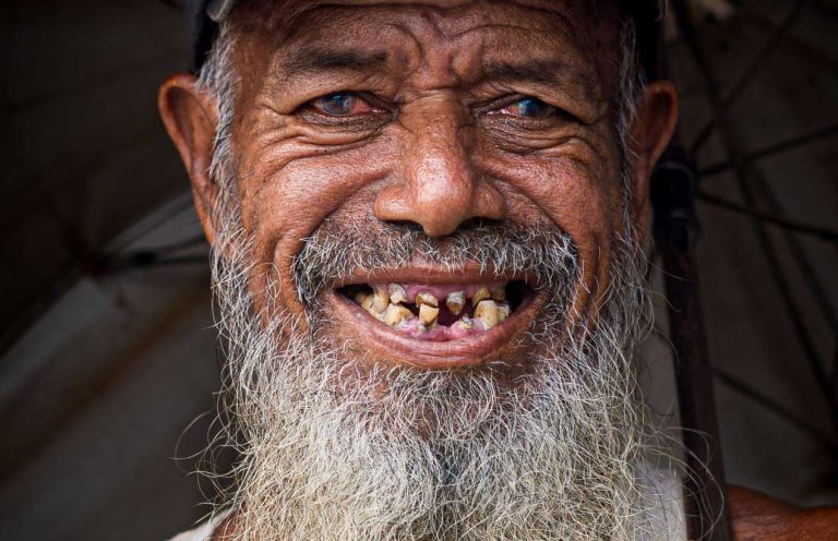 teeth-decay