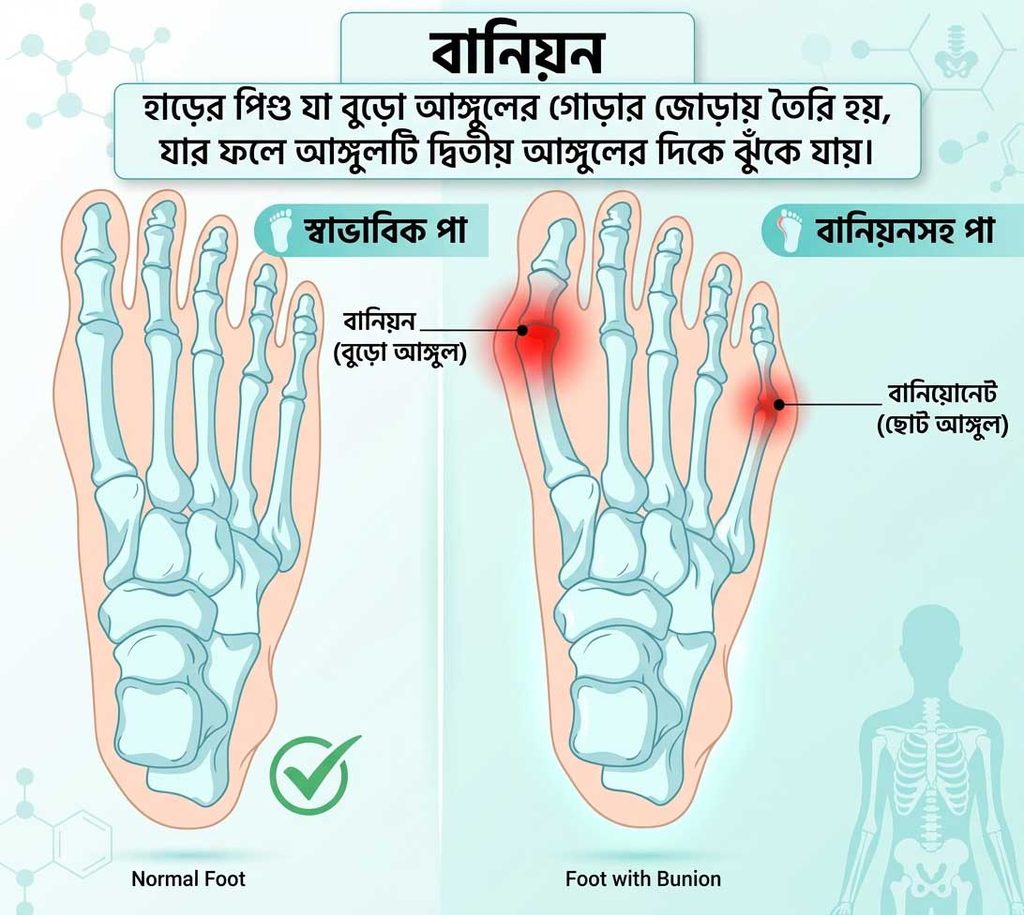 পায়ে বানিয়ন